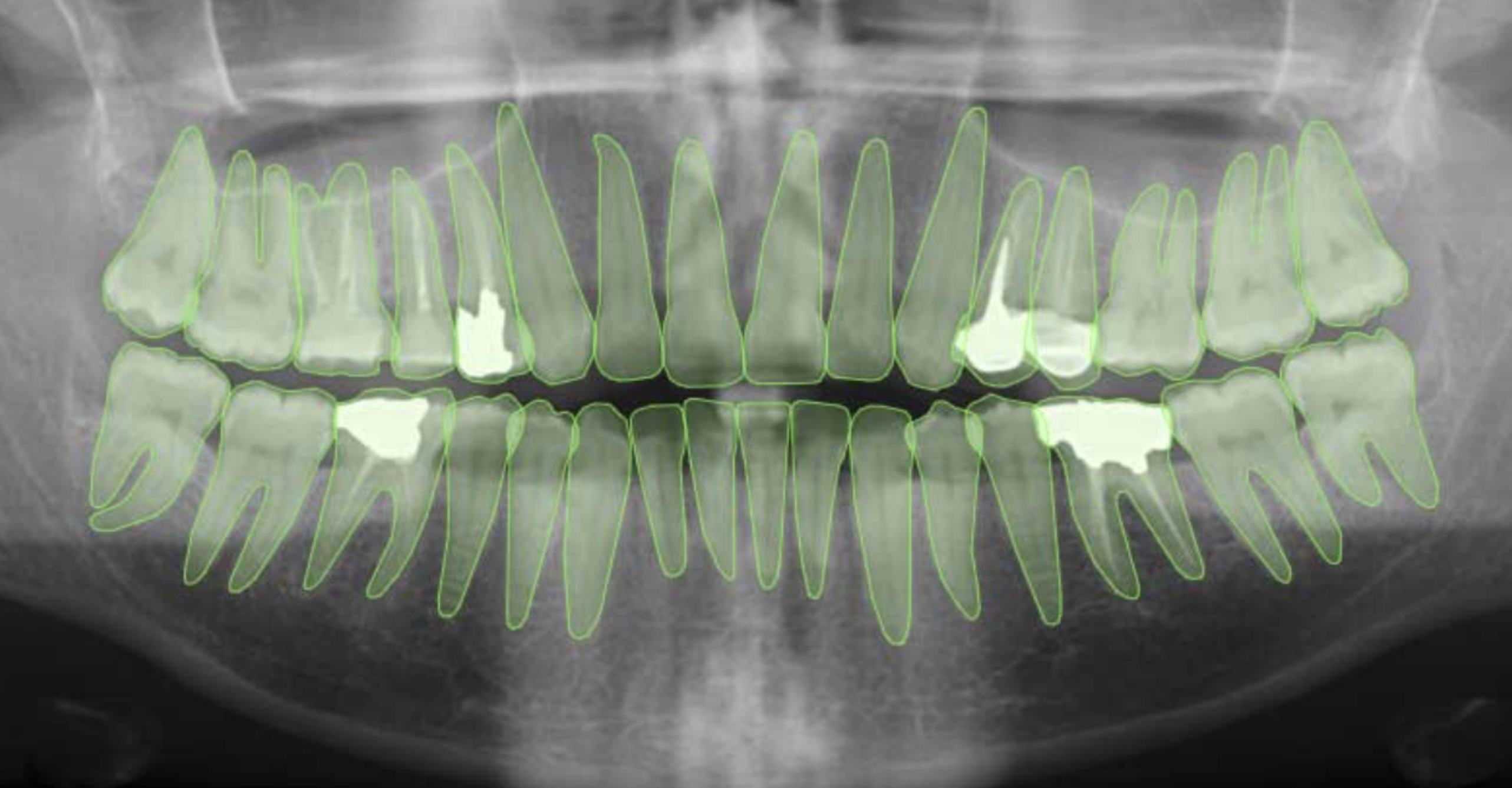 Teeth Segmentation Feature