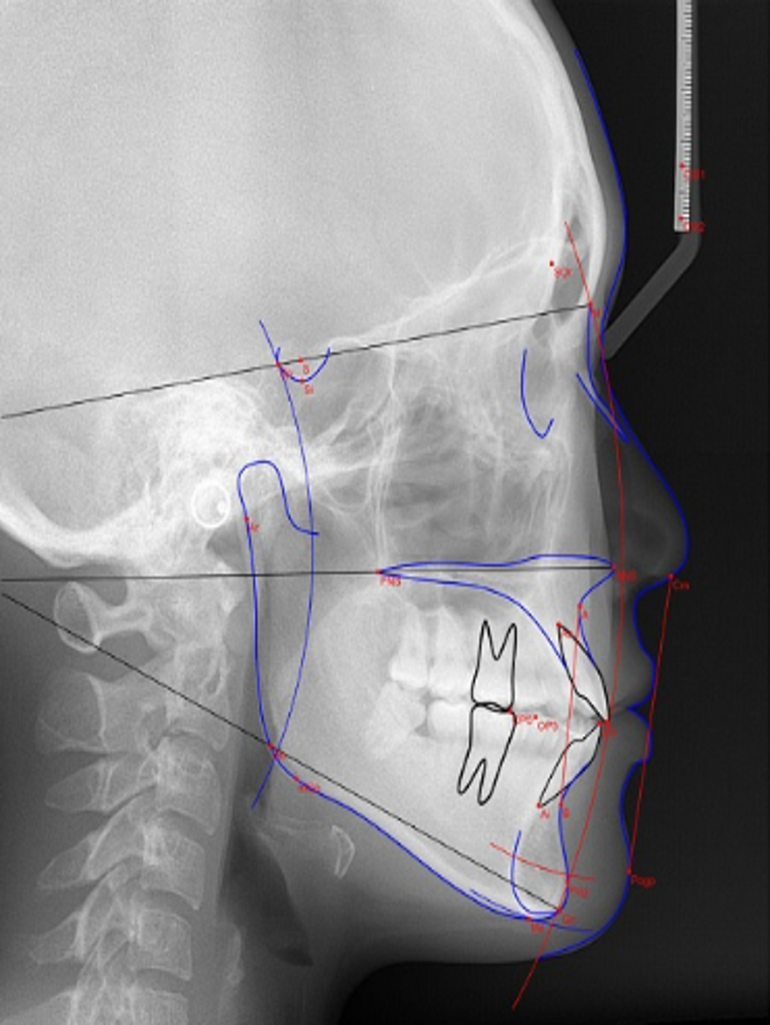 Cephalometric X-ray